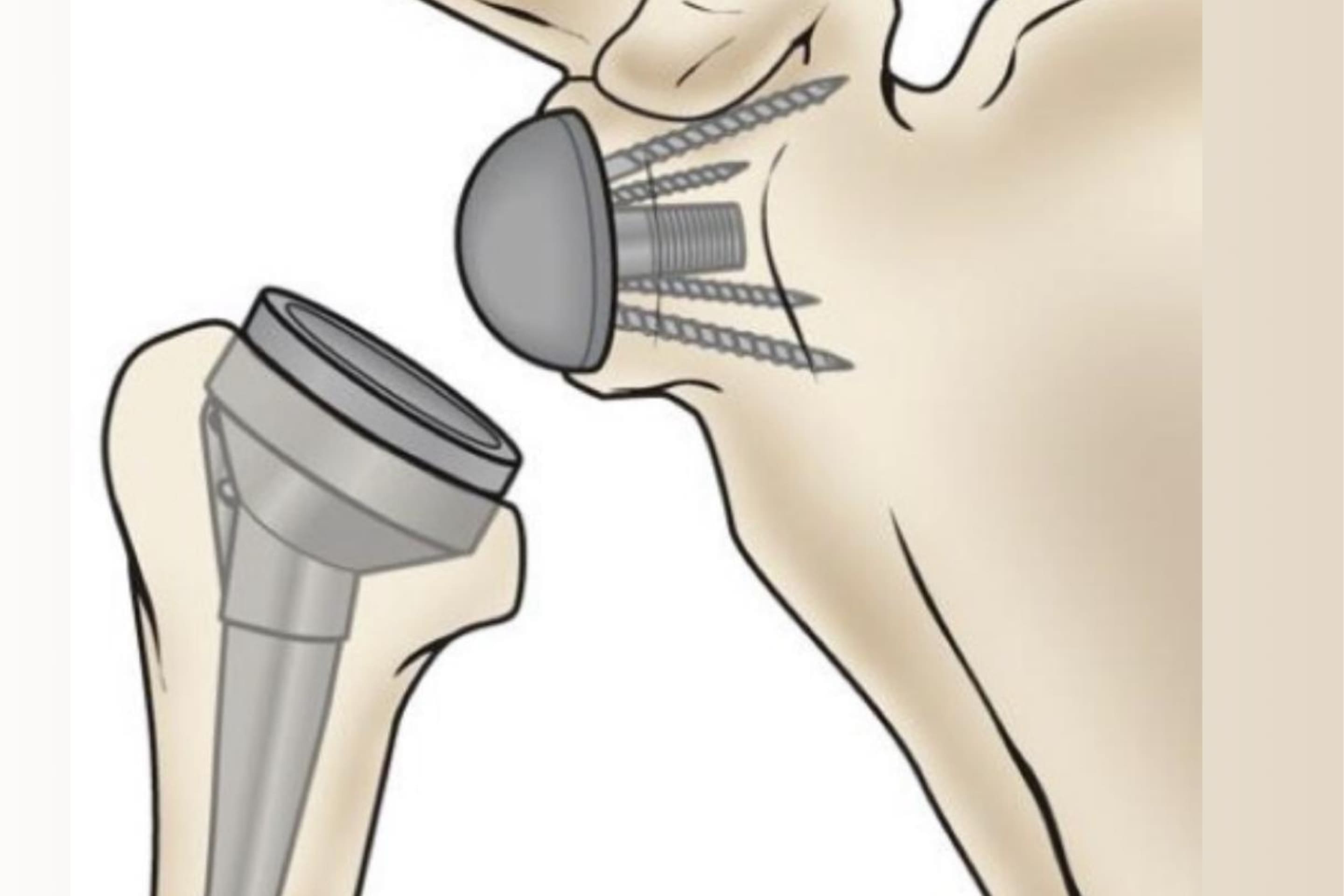 Cirugía para prótesis reversa de hombro ofrecido por Dr. Víctor Rodríguez Martínez - Especialista en Ortopedia