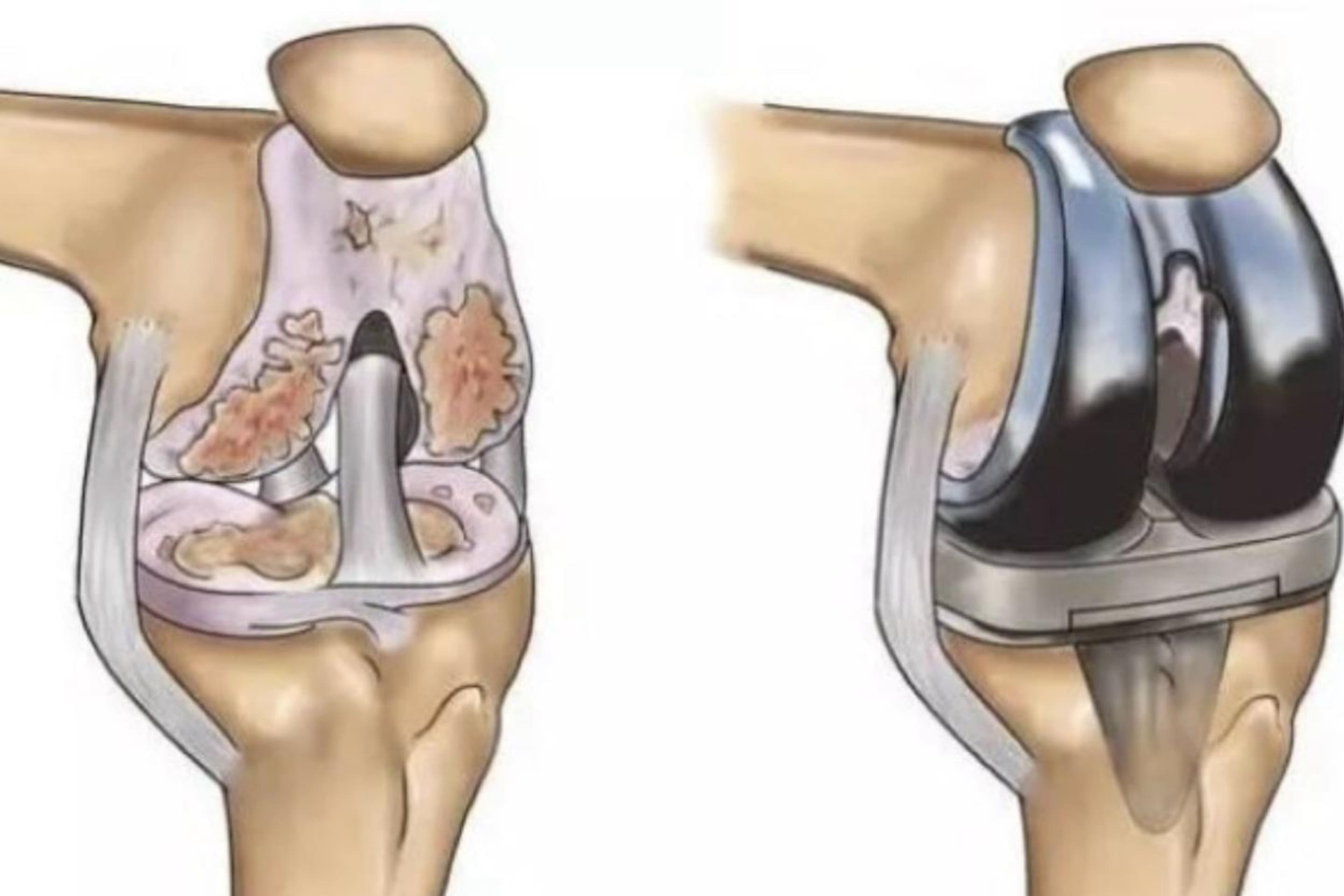 Cirugía de Prótesis de Rodilla