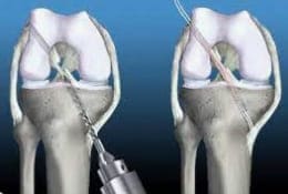 Reconstrucción de Ligamento Cruzado Anterior (LCA) por Artroscopia